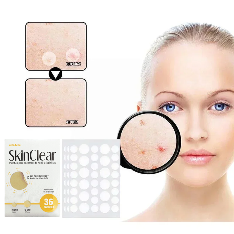 AcnePatch Skin Clear – ¡Parches para el control de acné y espinillas!